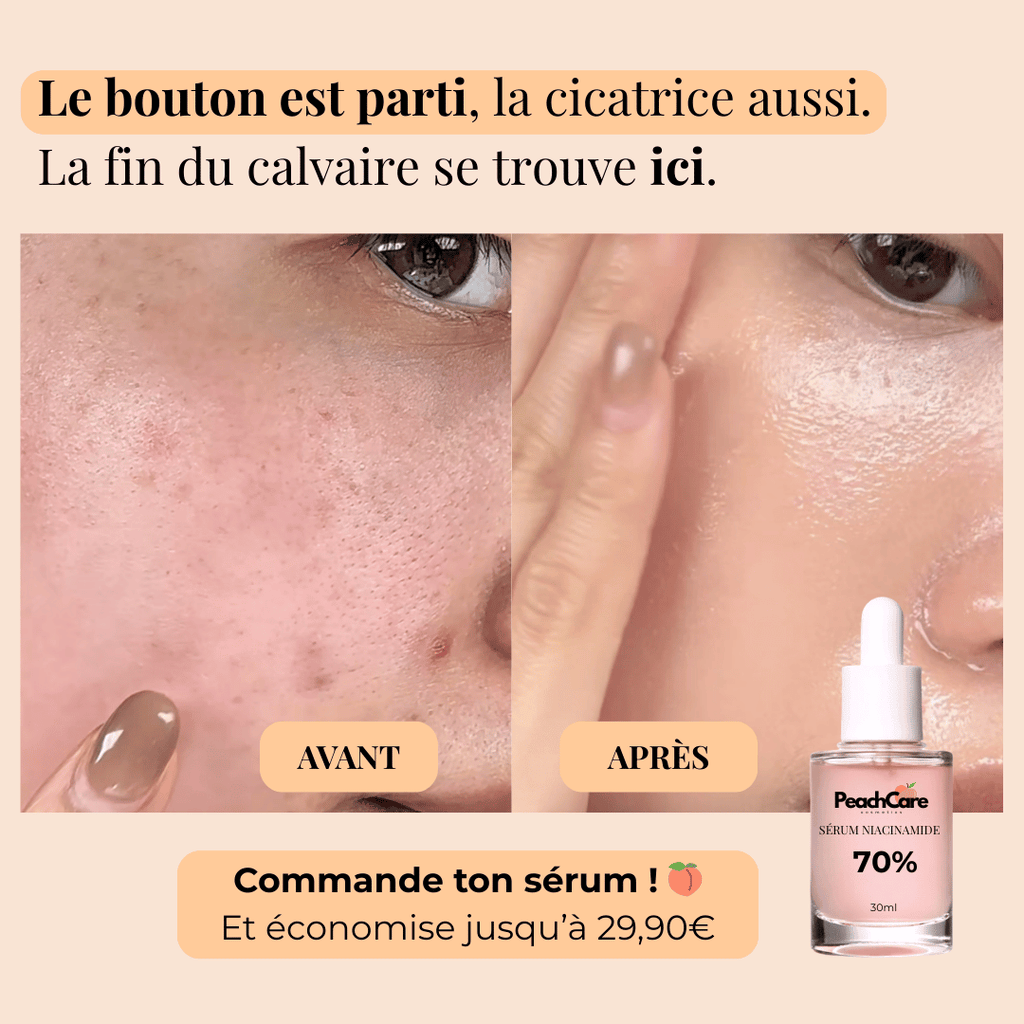 Sérum Niacinamide - Soin des cicatrices post-acné
