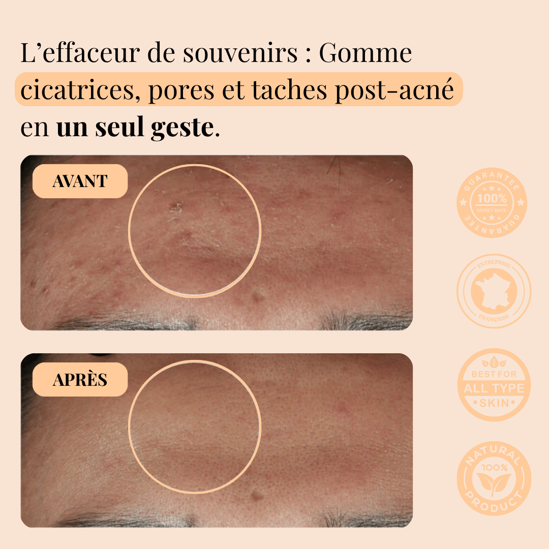 Sérum Niacinamide - Soin des cicatrices post-acné