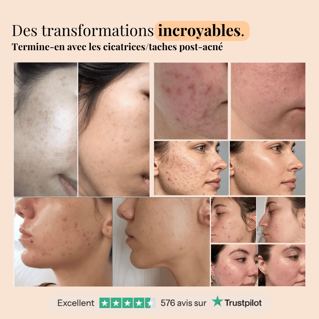 Sérum Niacinamide - Soin des cicatrices post-acné