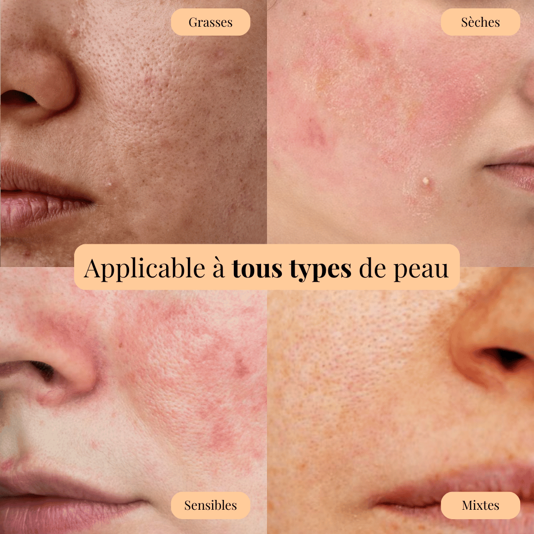 Sérum Niacinamide - Soin des cicatrices post-acné